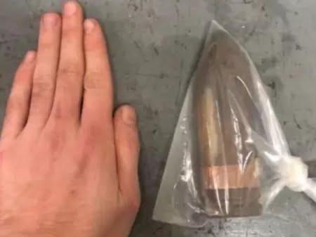 Homem com projétil de canhão no reto faz hospital acionar equipe antibomba