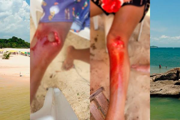 Imagens Fortes: Duas crianças foram atacadas por piranhas no Rio Tapajós em Itaituba no Pará
