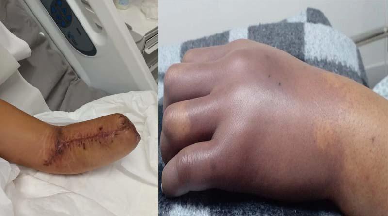 Mulher vai a hospital dar à luz e tem mão amputada